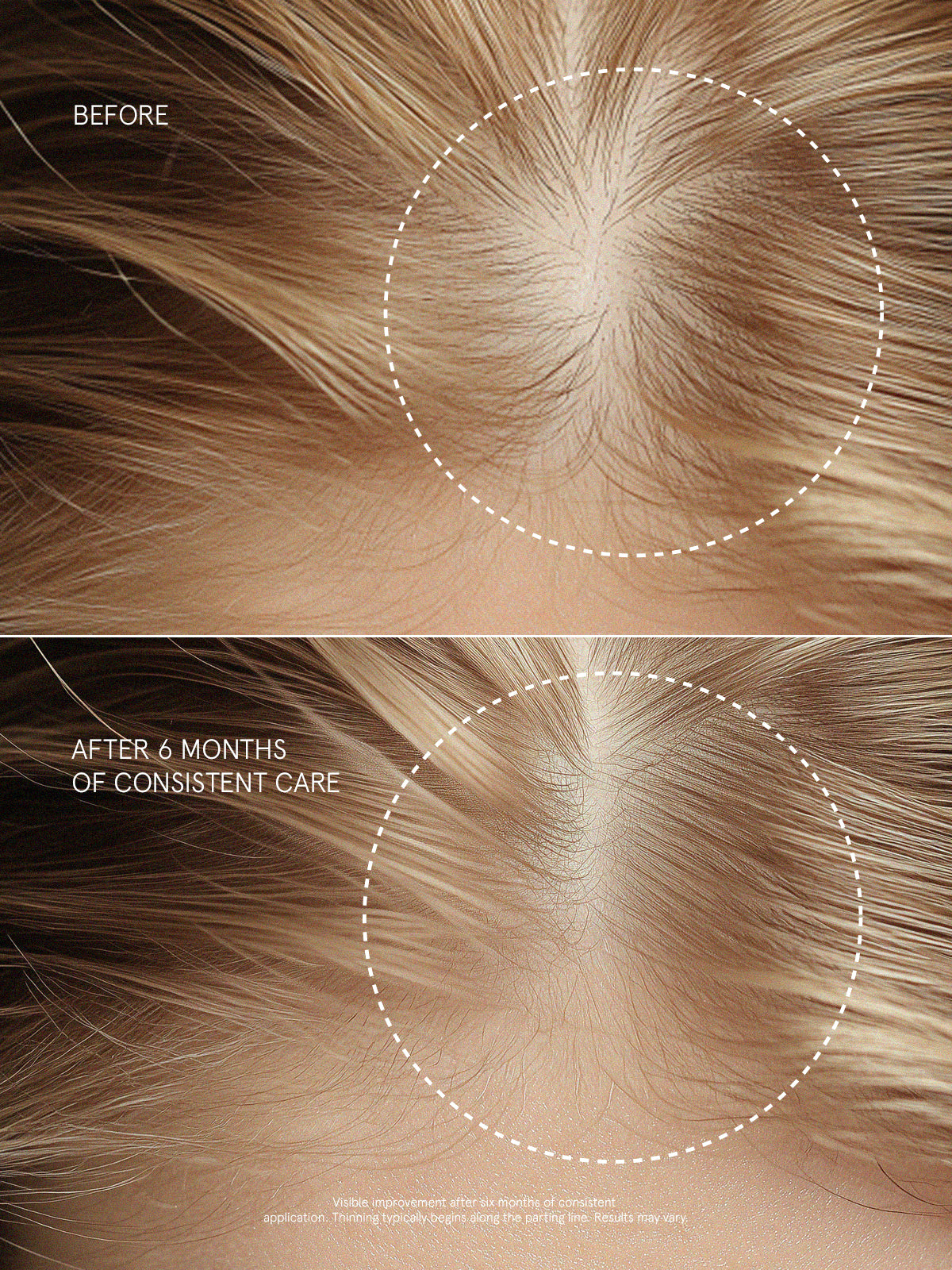 Visible improvement of hair density along the parting line after 6 months of consistent use with Pepti-Hair X Serum