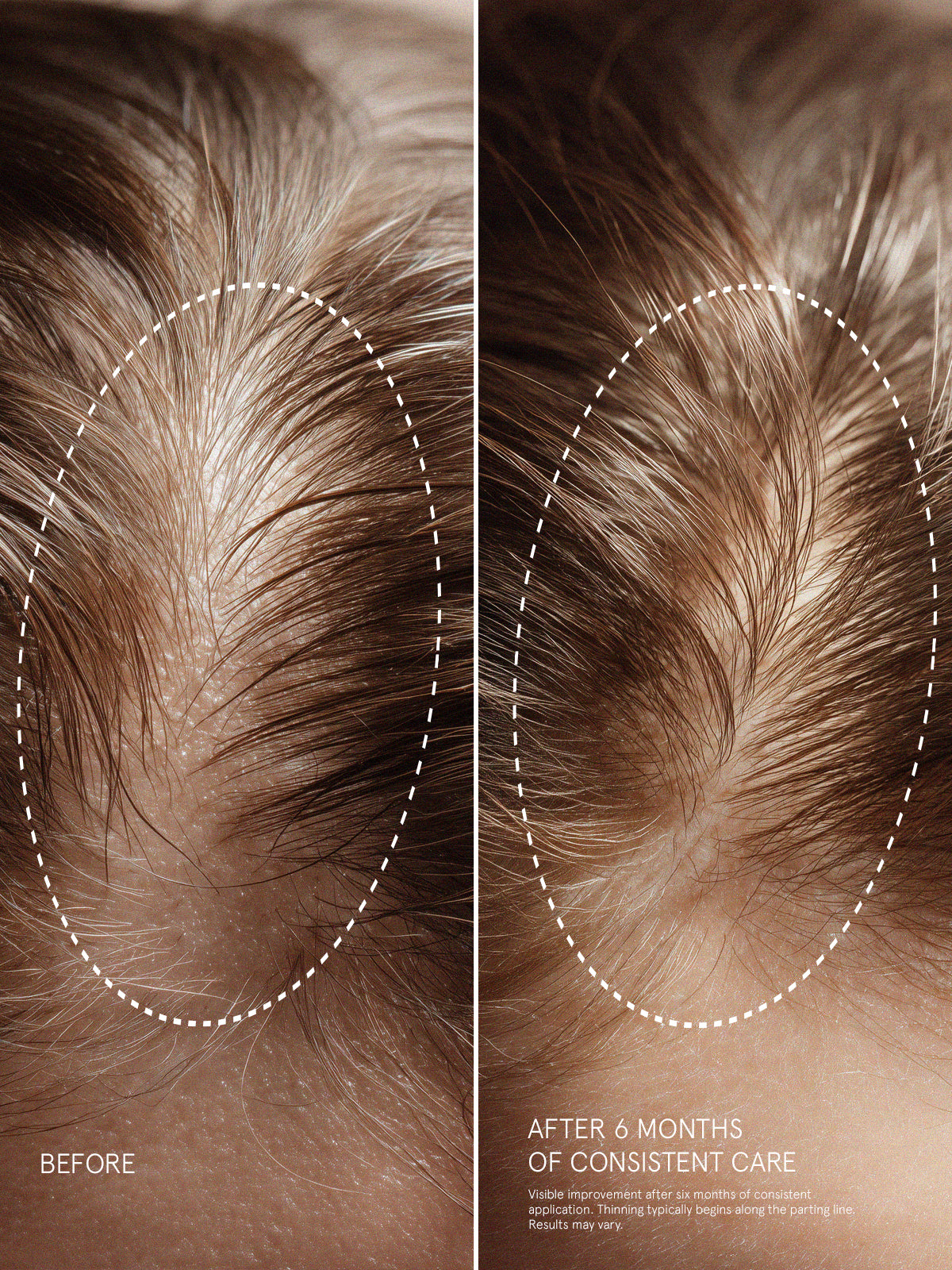 Visible improvement of hair density along the parting line after 6 months of consistent use with Pepti-Hair X Serum